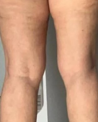 Back of thighs after eight sessions