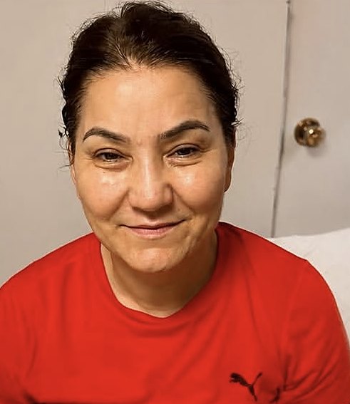 Client face after one microcurrent facial